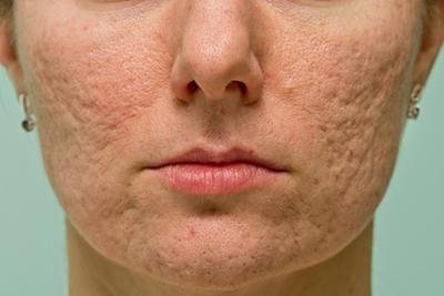 Best Treatments for Acne Scars: How a Dermatologist Can Help