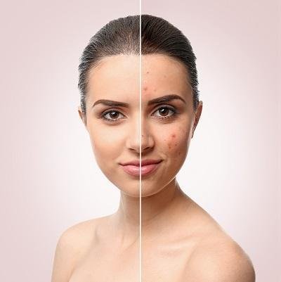 Common Acne Treatment Options