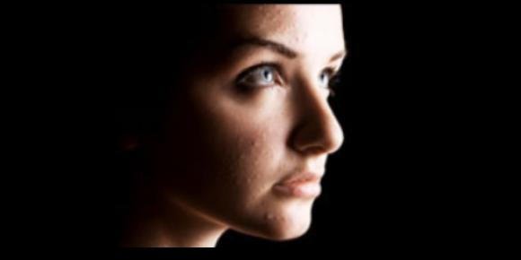 Dealing with Adult Acne
