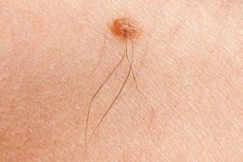 Detecting Melanoma