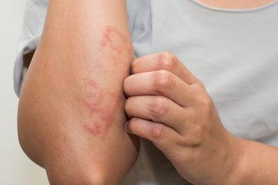 Dry Skin and Eczema Care: How to Protect Your Skin During Cooler Weather