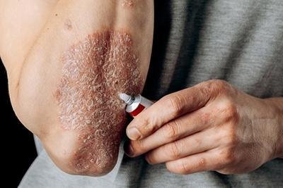 Eczema and Psoriasis: Understanding and Managing Chronic Skin Conditions