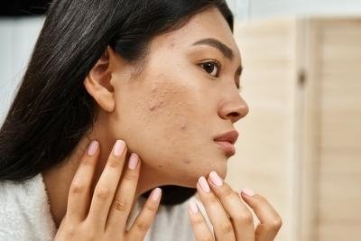 Effective Dermatologist-Recommended Treatments for Adult Acne