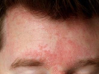 FAQs About Seborrheic Dermatitis