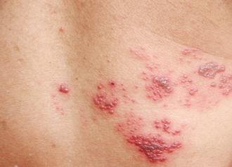 Finding The Right Treatment For Shingles