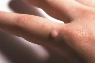 Finding the Right Treatment for Warts on Your Hands