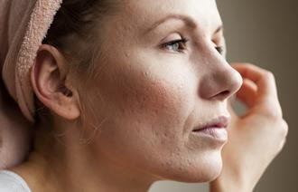 Healing Your Acne Scars