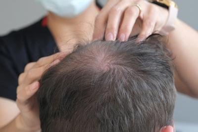 How a Dermatologist Can Help With Hair Loss and Scalp Issues