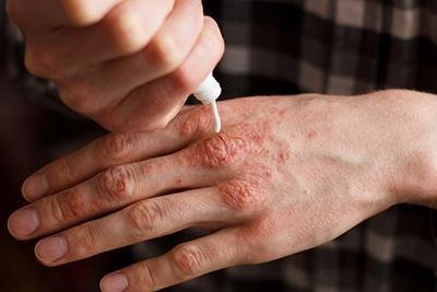 How to Treat and Prevent Eczema Flare-Ups
