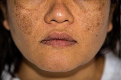 How to Treat and Prevent Hyperpigmentation