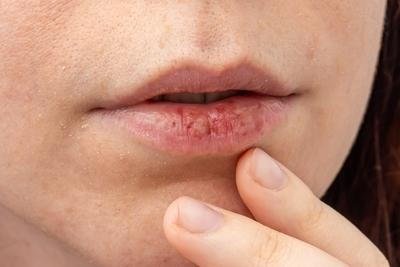 How Winter Weather Affects Your Skin Barrier: Protective Care Tips From Dermatologists