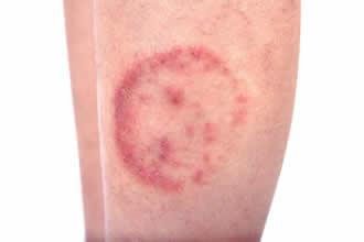 Is My Rash Ringworm or Something Else?