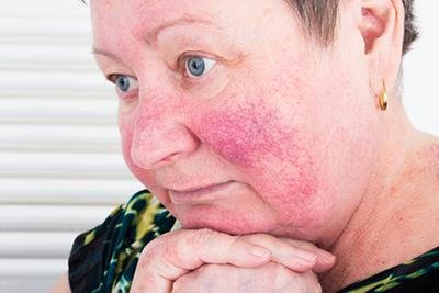 Managing Rosacea: Tips for Reducing Flare-Ups and Protecting Your Skin
