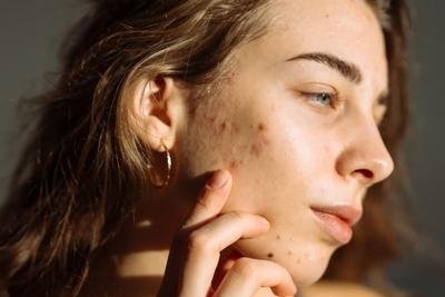 Treating Adult Acne: Beyond Teen Skincare Routines