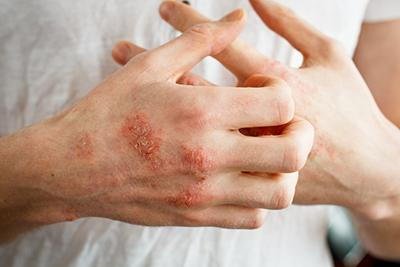 Treating Eczema in Adults