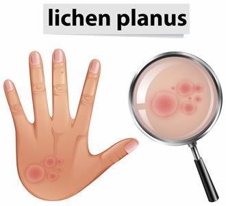 Treating Lichen Planus