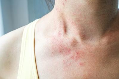 Treating Your Rashes