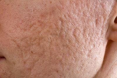 Treatment Options for Acne Scarring