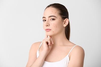 Treatment Options for Acne