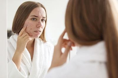 Treatment Options for Acne