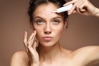 Understanding and Managing Acne