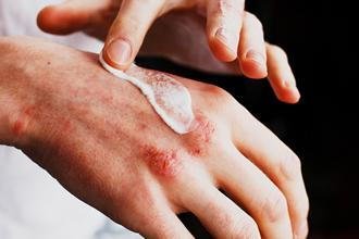 Understanding and Treating Eczema