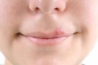 Understanding Cold Sores