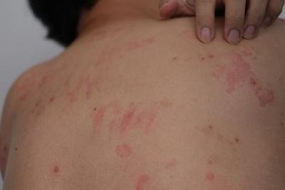 Understanding Hives: Common Triggers and Treatment Options