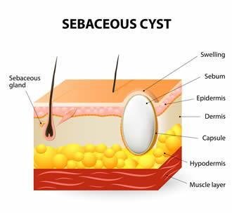 What Are Sebaceous Cysts?