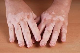 What Are Skin Pigmentation Disorders?