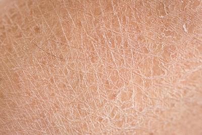 What Causes Dry Skin?