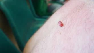 What Is a Skin Tag?