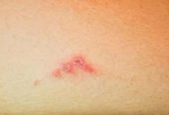 What Is Impetigo?