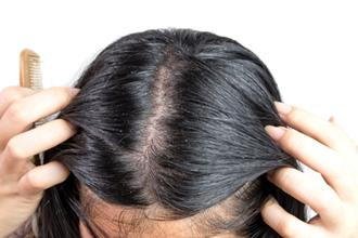 What Is Seborrheic Dermatitis?