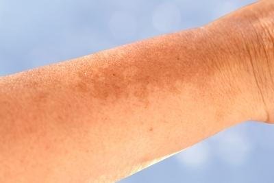 What to Know About Hyperpigmentation and Uneven Skin Tone