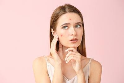 What Types of Treatments Are There for Acne?