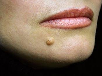 When is a Mole Dangerous?